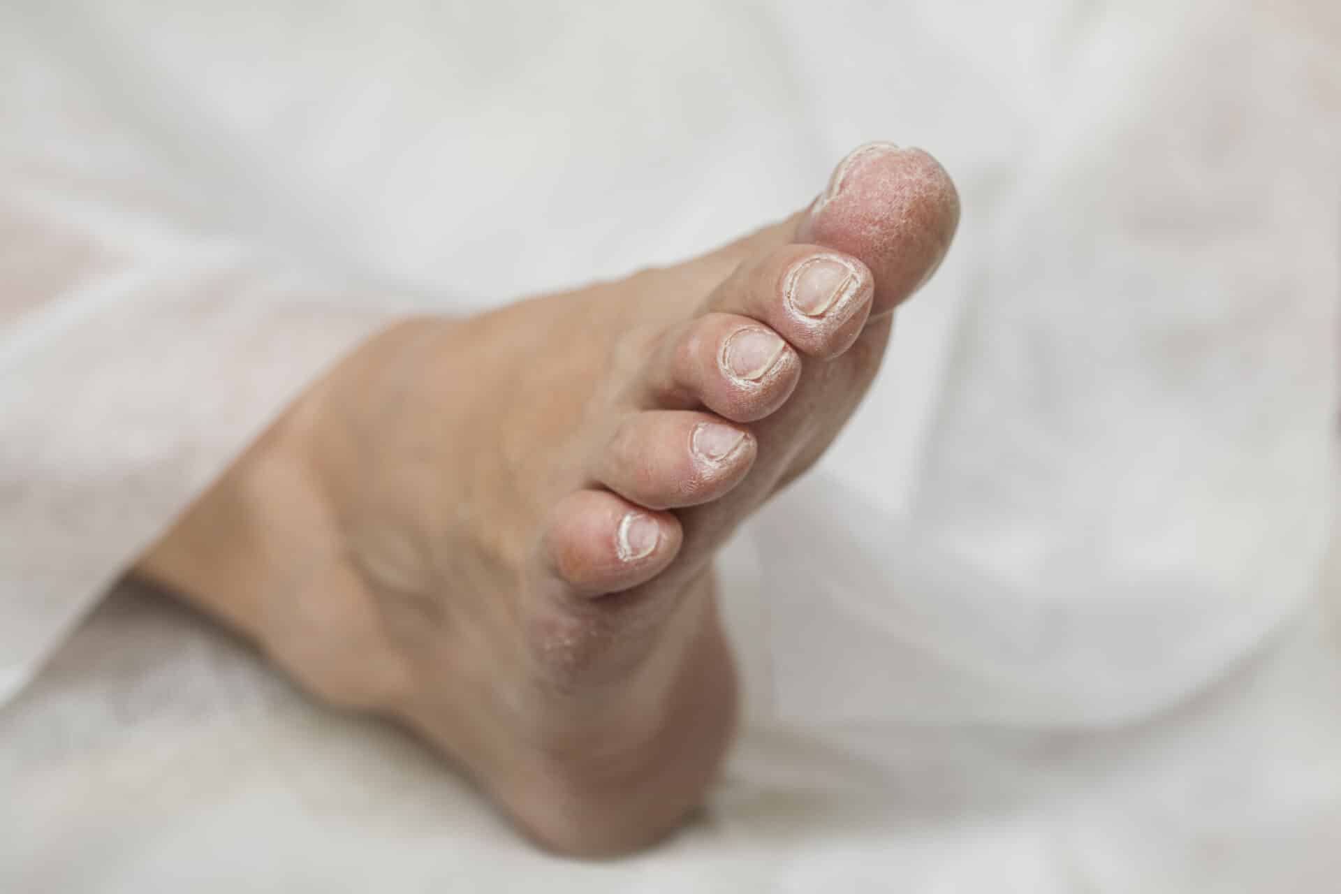 Diabetic foot - Health Tips, Diabetic foot Health Articles, Health News |  TheHealthSite.com